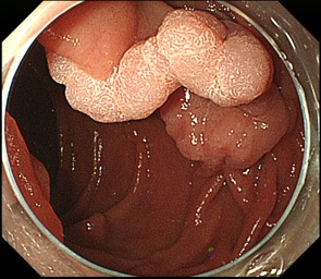 腫瘍 十二指腸 十二指腸粘膜下腫瘍について